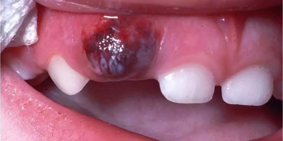 Cisto de erupção | Você já ouviu falar? – Clinica Primeiro Sorriso ...