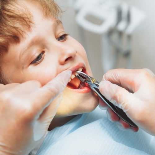 retrato-de-um-paciente-infantil-e-as-maos-de-um-dentista-pediatrico-com-pinca-dental-closeup-extracao-indolor-de-dentes-odontopediatria